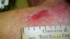 Otober 21, 2012      9 days after canna-vaseline (2).jpg