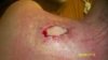 Sept 2012 2 days after Mohs.jpg