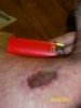 Sept 2012 7 days after Mohs.jpg
